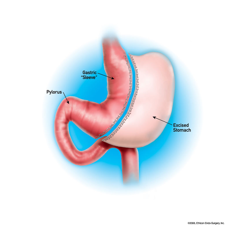 photo_ft_news_bariatric_110619 (1).jpg